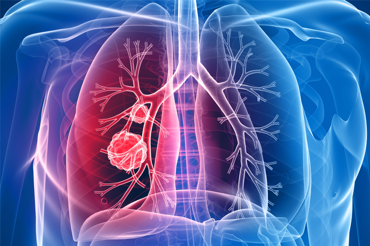 What You Should Know If You Have Lung Cancer