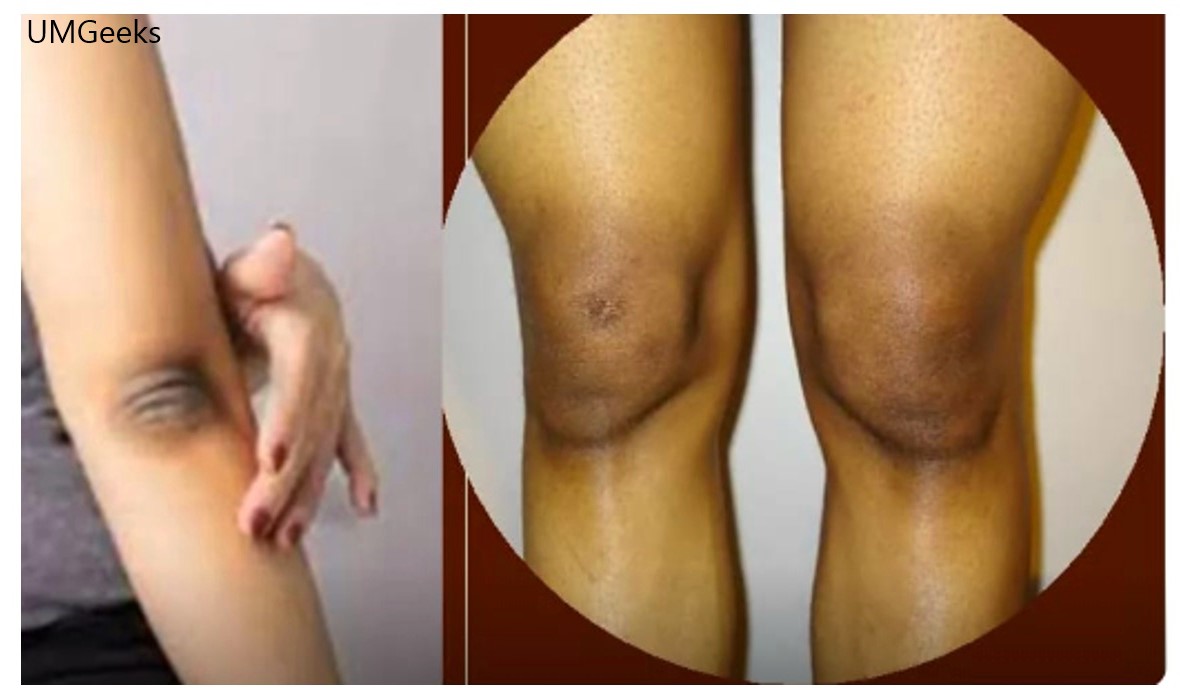 Do black elbows and knees bother you? Experts recommend treatment