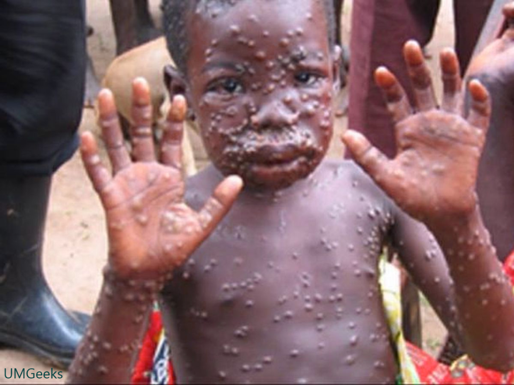 Monkey Pox: How Dangerous is the Monkey Pox?