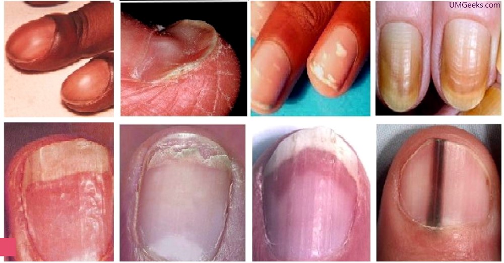 Some changes in the nails always indicate a serious problem
