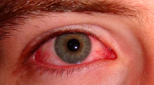 Eye flu