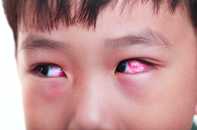 Eye flu in Children