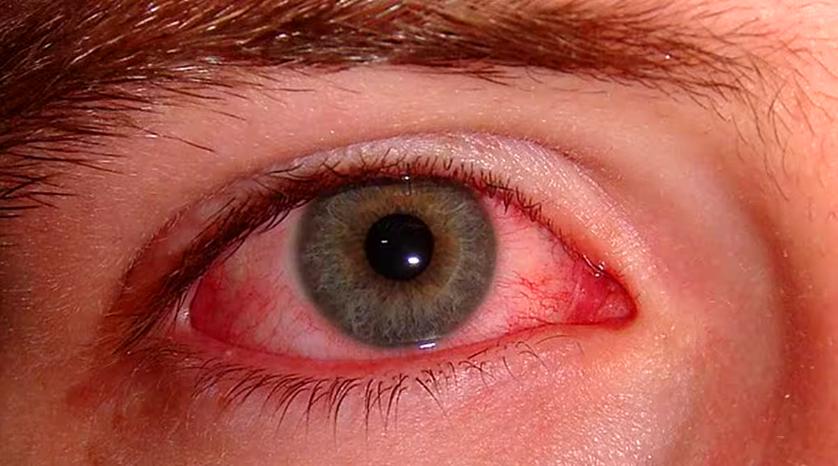 What is Eye flu (Conjunctivitis): Causes, Symptoms and Treatment