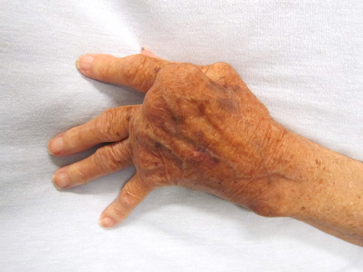 Rheumatoid Arthritis: Everything You Want to Know