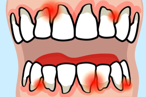 Teeth and Rheumatoid Arthritis