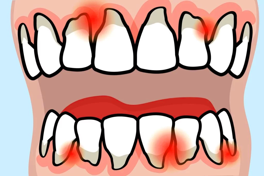 Teeth and Rheumatoid Arthritis: What You Need To Know