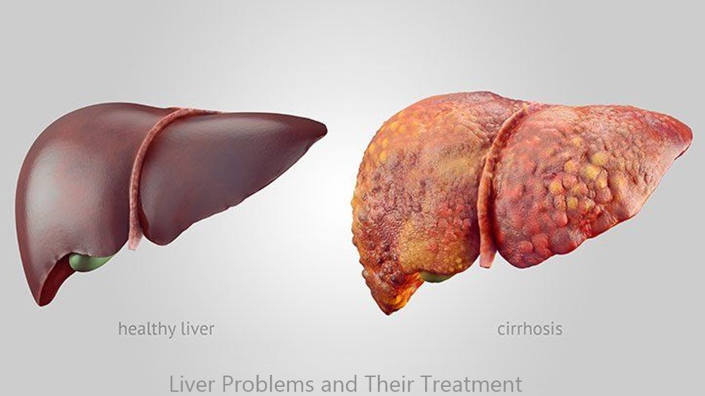 Symptoms of Liver Problems and Their Treatment