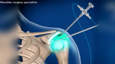 Shoulder surgery specialists