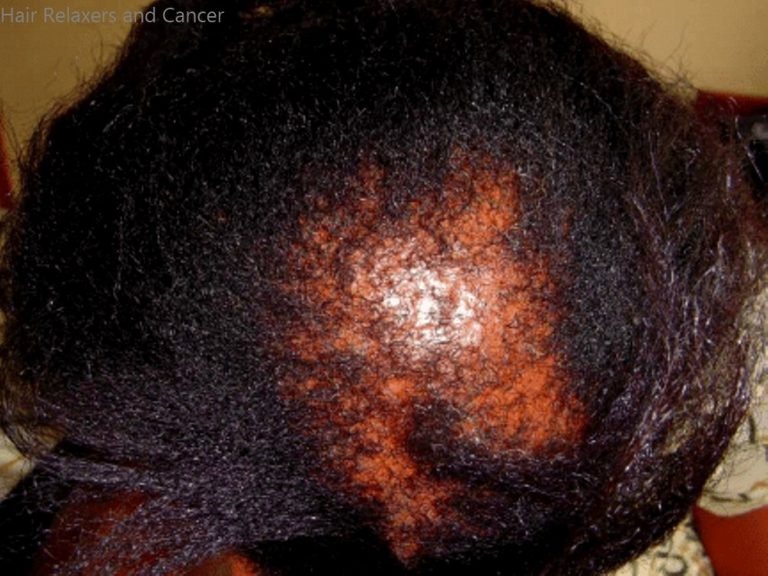 Hair Relaxers and Cancer