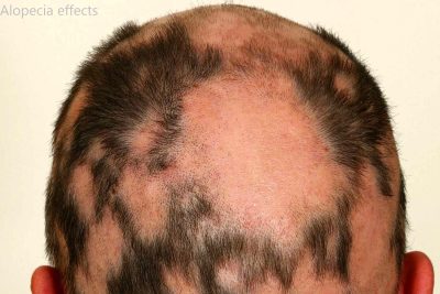 Alopecia effects
