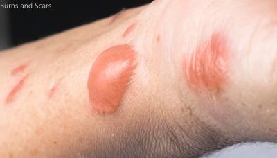 Burns and Scars