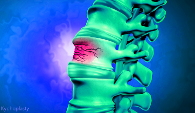 Kyphoplasty