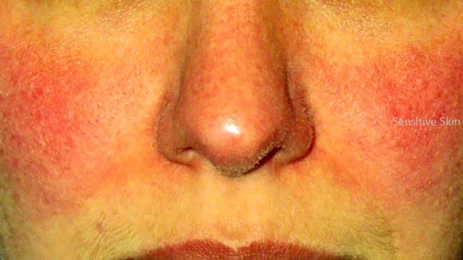 Sensitive Skin Care in 2025 Tips, Causes, and Safe Ingredients